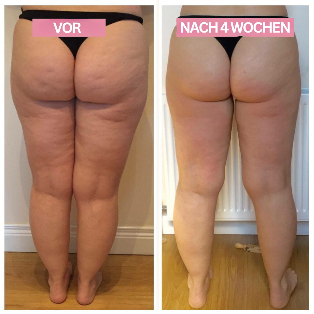 Anti-Cellulite-Cupping-Gerät – SlimCupp